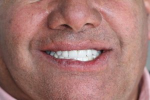 Con innovadora técnica clínica, recuperan la sonrisa de paciente del Sistema de Salud Naval Con innovadora técnica clínica, recuperan la sonrisa de paciente del Sistema de Salud Naval